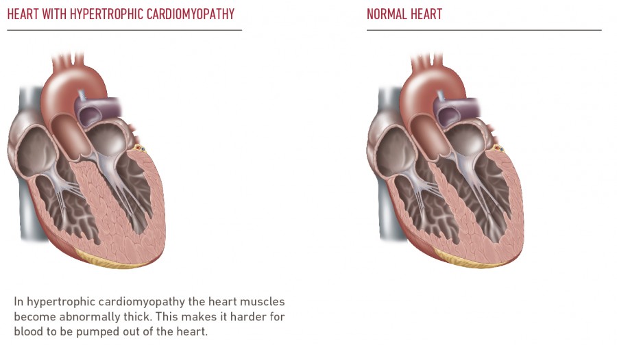 Hypertrophic Cardiomyopathy