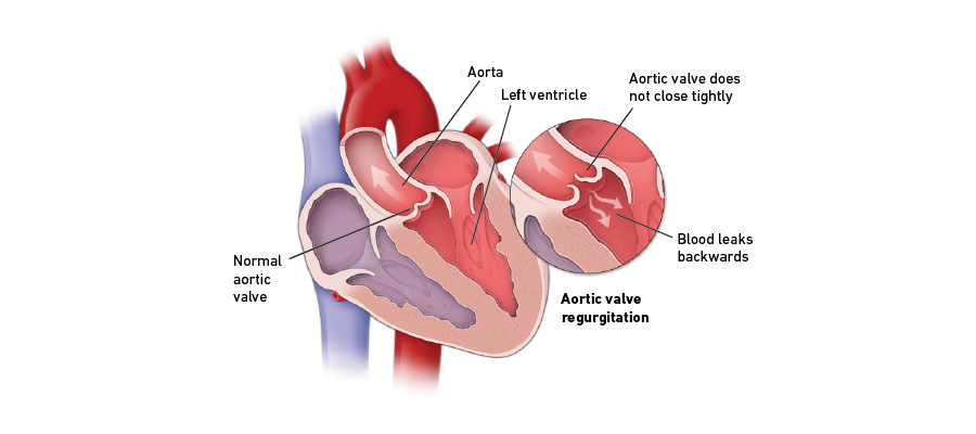 Aortic valve regurgitation graphic