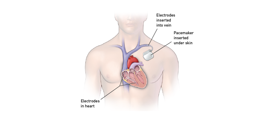 Inserted pacemaker graphic