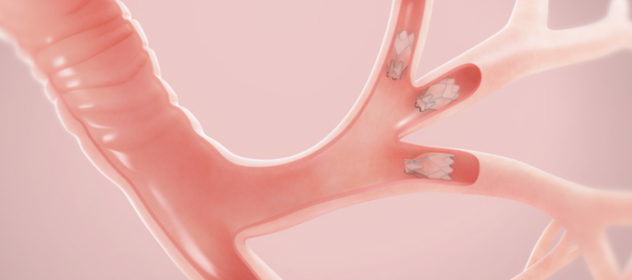 Graphic of Zephyr® Endobronchial Valve in lobe of the lung