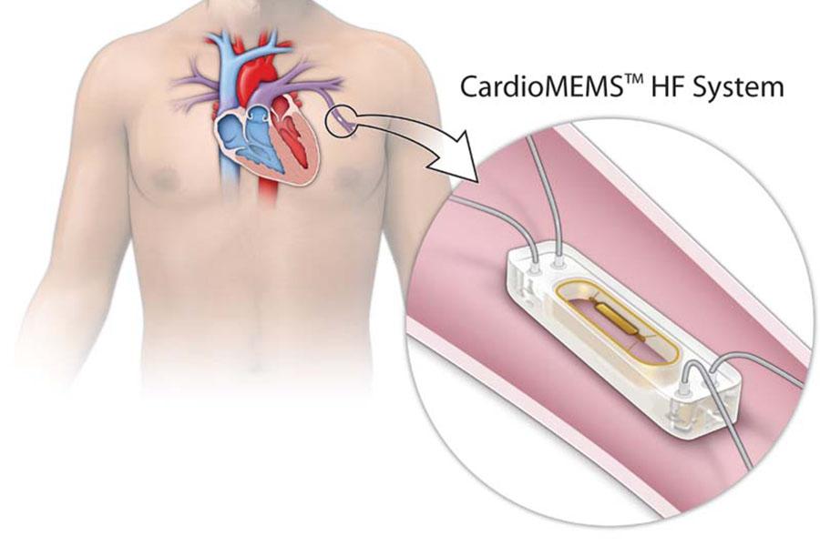 Illustration of the CardioMEMS Heart Failure System
