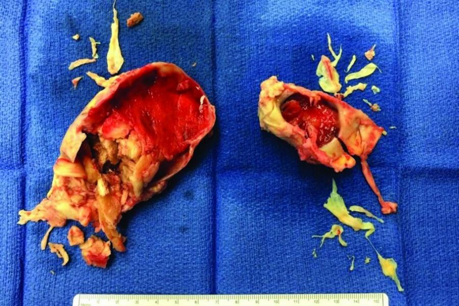 Extensive chronic clot removed from both of Kevin's lungs