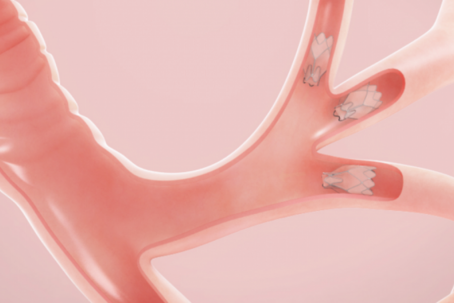 Graphic of Zephyr® Endobronchial Valve in lobe of the lung