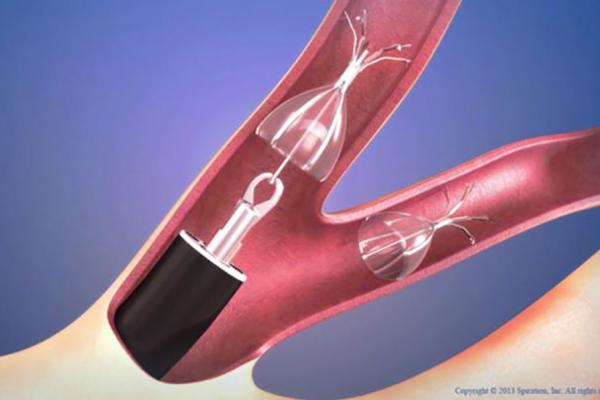Graphic of  spiration valve removal with forceps